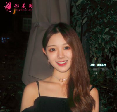 厦门华美于璇切开双眼皮案例 厦门华美于璇切开双眼皮案例