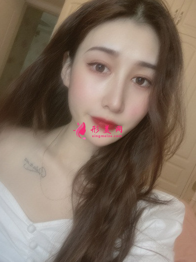 李院长面部填充术后图