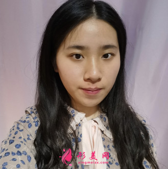 天姿医疗美容医院李烈面吸案例