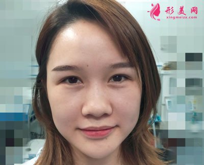 武汉韩辰医疗美容医院吴辉鼻部整形案例对比图 武汉韩辰医疗美容鼻部多项案例