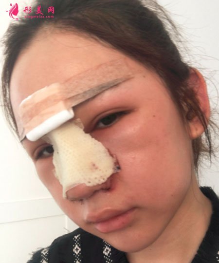 武汉韩辰医疗美容医院吴辉鼻部整形案例对比图 武汉韩辰医疗美容鼻部多项案例