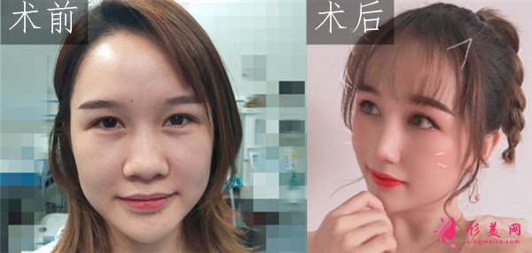 武汉韩辰医疗美容医院吴辉鼻部整形案例对比图 武汉韩辰医疗美容鼻部多项案例