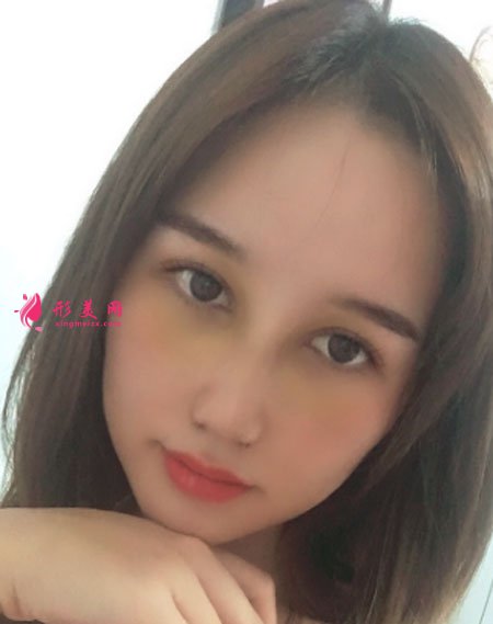 武汉韩辰医疗美容医院吴辉鼻部整形案例对比图 武汉韩辰医疗美容鼻部多项案例