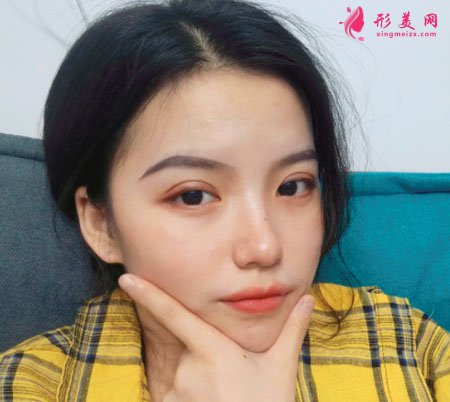 重庆美圣美邦医疗美容邓刚双眼皮案例对比图 重庆美圣美邦医疗美容眼部多项案例