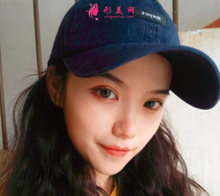 重庆美圣美邦医疗美容邓刚双眼皮案例对比图 重庆美圣美邦医疗美容眼部多项案例