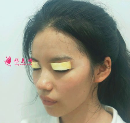 重庆美圣美邦医疗美容邓刚双眼皮案例对比图 重庆美圣美邦医疗美容眼部多项案例