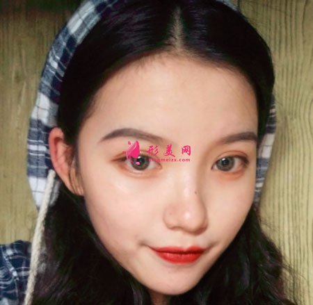 重庆美圣美邦医疗美容邓刚双眼皮案例对比图 重庆美圣美邦医疗美容眼部多项案例