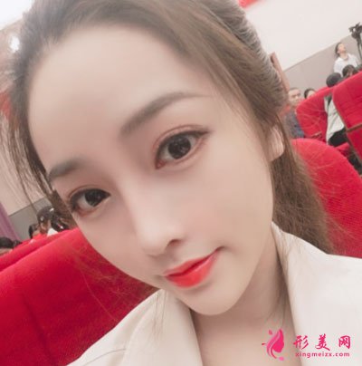 宁波珈禾肋软骨隆鼻案例