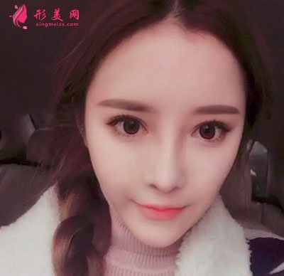 上海喜美医疗美容鼻部修复案例