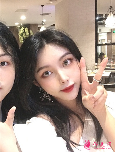 成都艺星周顺波隆鼻效果怎么样_假体硅胶隆鼻_真人案例