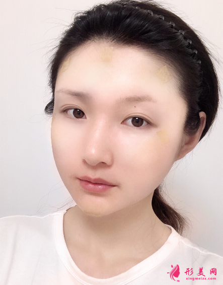 成都铜雀台做自体脂肪面部填充多少钱？价格表？有没有失败案例