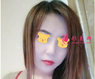 成都成美郑敏做鼻子术后效果 成都成美郑敏做鼻子怎么样?