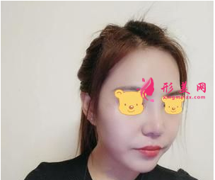 成都成美郑敏做鼻子怎么样? 成都成美郑敏做鼻子怎么样?