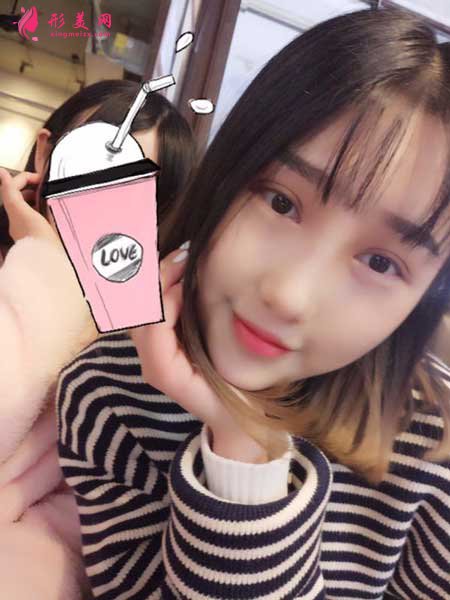 双眼皮修复术后10天