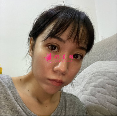 深圳福华整形医院李敏双眼皮