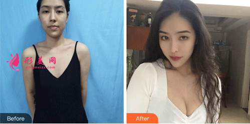 北京叶子整形医院鲁礼新隆胸 隆胸手术前后对比