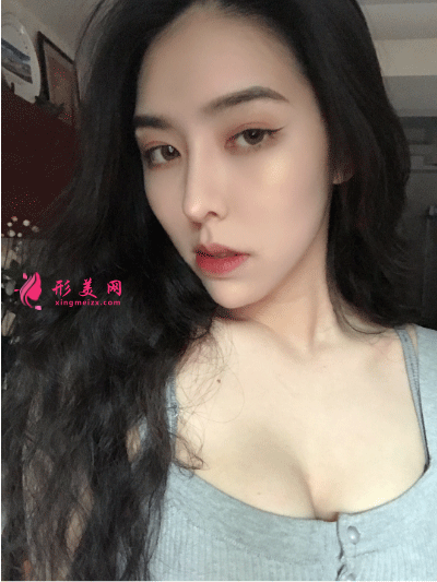 北京叶子整形医院鲁礼新隆胸 隆胸一个月后