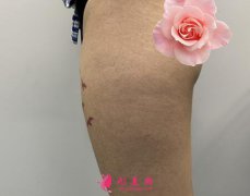 上海九院整形科大腿吸脂怎么样?真人案例效果对比图看技术