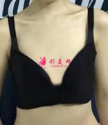 上海九院隆胸怎么样？看曹卫刚医生自体脂肪隆胸案例！