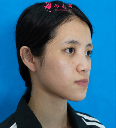 武汉美亚金国华面部脂肪填充 武汉美亚金国华面部脂肪填充