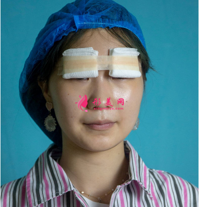 武汉美亚整形医院刘佳亮双眼皮 武汉美亚整形医院刘佳亮双眼皮