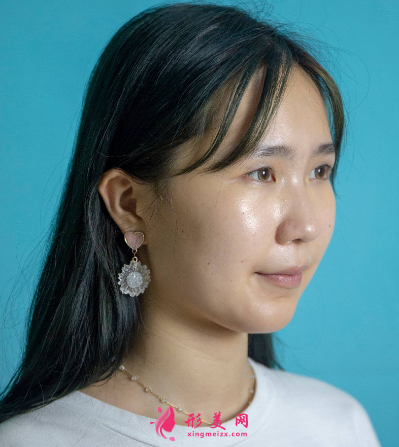 武汉美亚整形医院刘佳亮双眼皮 武汉美亚整形医院刘佳亮双眼皮