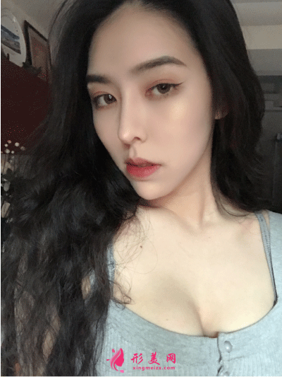 北京叶子整形医院鲁礼新隆胸 隆胸一个月后