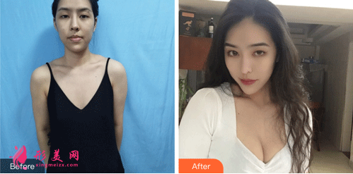 北京叶子整形医院鲁礼新隆胸 隆胸手术前后对比