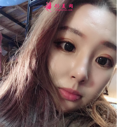 深圳江南春天李刚隆鼻技术