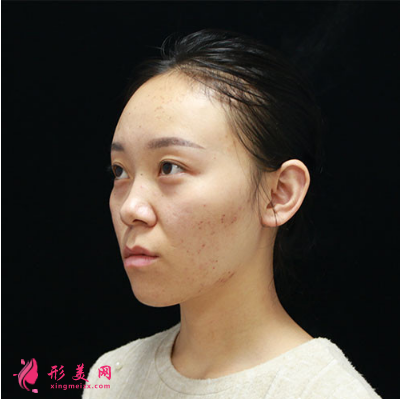 北京圣嘉新整形医院康华去痘坑