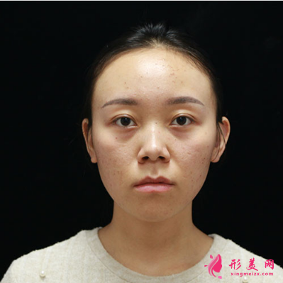 北京圣嘉新整形医院康华去痘坑