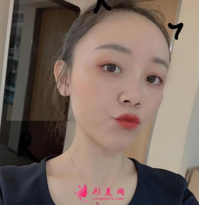 北京圣嘉新整形医院康华去痘坑