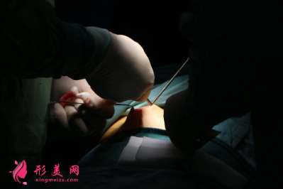 北京知音整形医院马群做鼻综合