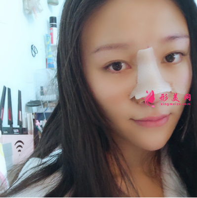 北京知音整形医院马群做鼻综合