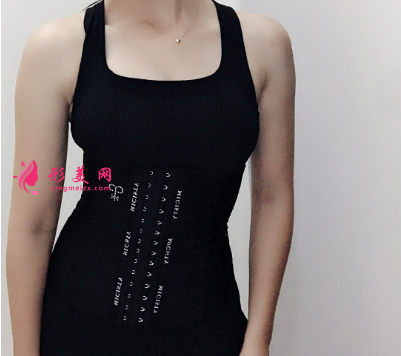 深圳非凡王天成腰部吸脂 深圳非凡王天成腰部吸脂