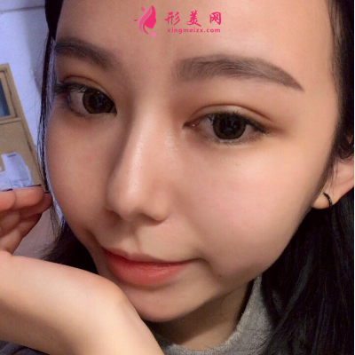 深圳非凡整形医院梅够明隆鼻手术 深圳非凡整形医院梅够明隆鼻手术