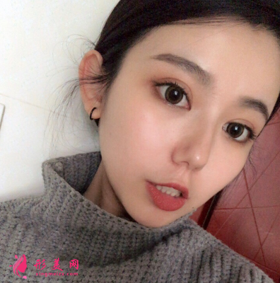 深圳非凡整形医院梅够明隆鼻手术 深圳非凡整形医院梅够明隆鼻手术