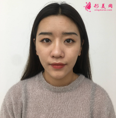 武汉德美余萌隆鼻术