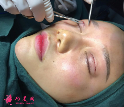 武汉德美刘小伟双眼皮 武汉德美刘小伟双眼皮