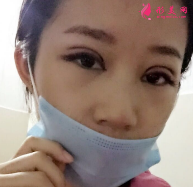 武汉德美刘小伟双眼皮 武汉德美刘小伟双眼皮