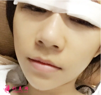 武汉德美刘小伟双眼皮 武汉德美刘小伟双眼皮