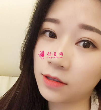 武汉德美刘小伟双眼皮 武汉德美刘小伟双眼皮