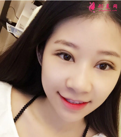 武汉德美刘小伟双眼皮 武汉德美刘小伟双眼皮