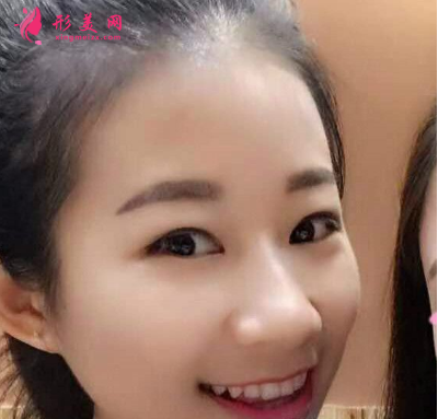 武汉德美刘小伟双眼皮 武汉德美刘小伟双眼皮