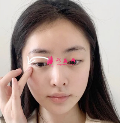 武汉华亚整形医院李爱林面部除皱 武汉华亚整形医院李爱林面部除皱