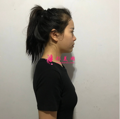 武汉一美彭义坤假体隆胸