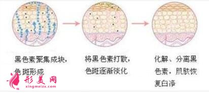 去除脸上黄褐斑有哪些方法?效果好吗?