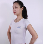 重庆西南医院整形科隆胸效果实拍图展示