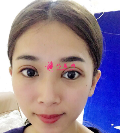 武汉韩辰整形医院李相奇双眼皮案例 武汉韩辰整形医院李相奇双眼皮案例