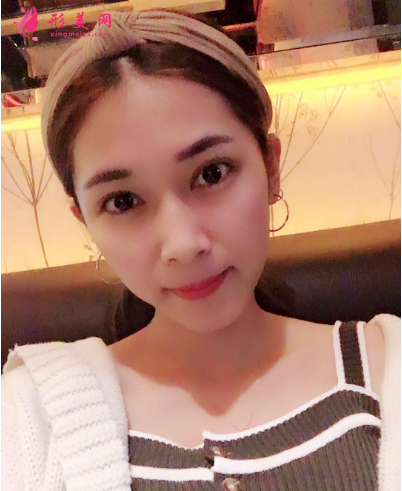 武汉韩辰整形医院李相奇双眼皮案例 武汉韩辰整形医院李相奇双眼皮案例